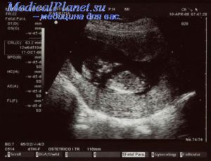 При беременности неоднородная плацента