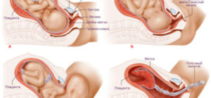 Когда протыкают пузырь у беременных через сколько рожают