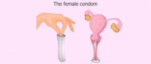 Что делать если остался презерватив