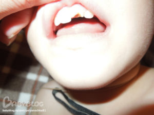 Ребенок разбил губу изнутри зубами