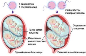 Симптомы двойни при беременности