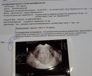 На какой неделе можно определить по узи беременность