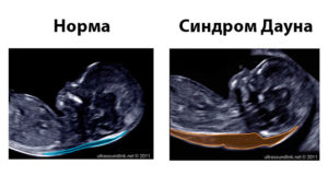 Можно ли увидеть на узи дцп при беременности