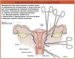 Заместительная гормональная терапия после удаления матки и яичников