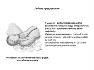 При лобном предлежании доношенного плода родоразрешение проводят