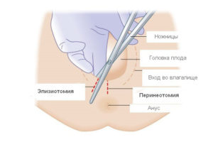 Восстановление после родов с эпизиотомией