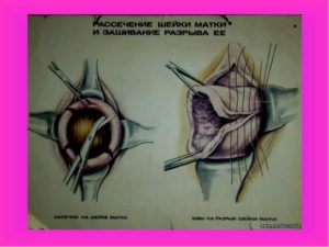 Как накладывают швы на шейку матки при беременности