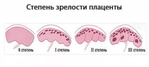 Раннее созревание плаценты на 32 неделе 2 стадия