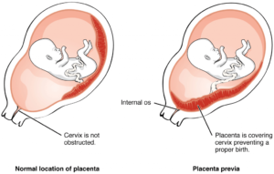Плацента по передней стенке матки что значит
