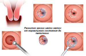 Большая шейка матки почему