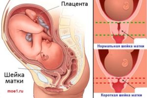 Шейка матки короткая во время беременности