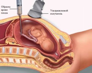 Прокол матки при беременности