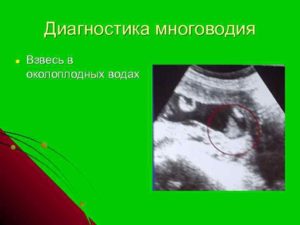 Взвеси в околоплодных водах на 19 неделе беременности