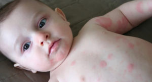 Аллергия на порошок у новорожденного
