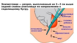 После эпизиотомии когда можно садиться