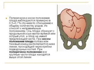 Поперечное положение плода причины