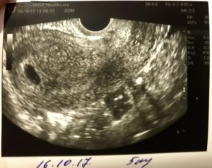 5 неделя беременности на узи не видно эмбриона