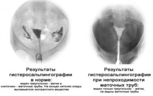 Через какое время после рентгена можно беременеть