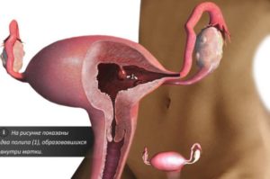 Беременность после гиперплазии эндометрия
