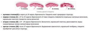 Раннее созревание плаценты на 32 неделе 2 стадия