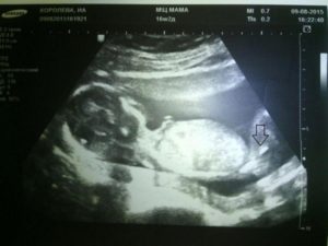 На 16 недели беременности можно узнать пол ребенка