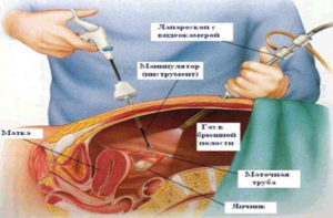 Стимуляция овуляции после лапароскопии