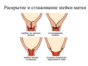 Сглажена шейка что значит