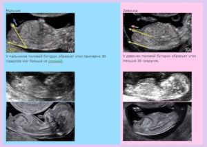 Можно узнать пол ребенка на 12 неделе беременности