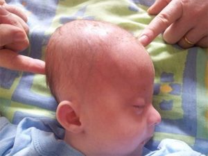 Почему у новорожденного вытянутая голова