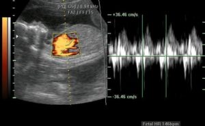 Сердцебиение глухое у плода