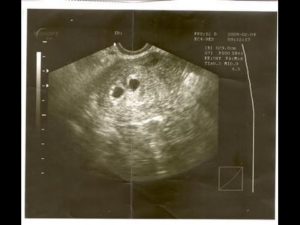 4 недели беременности двойня
