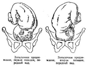 Головное предлежание плода 1 позиция передний вид