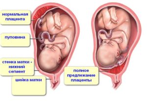 Плацента расположена по задней стенке матки в дне