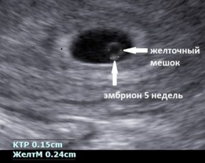 На какой неделе беременности видно эмбрион на узи