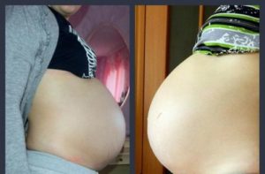 Каменеет живот 18 недель беременности