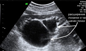 Расширение лоханки при беременности