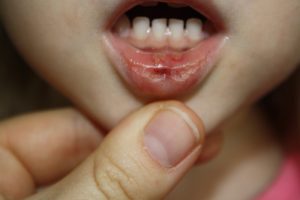 Ребенок разбил губу изнутри зубами