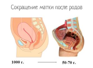 Как после родов чистят матку