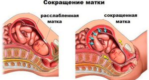 Сокращение матки без беременности