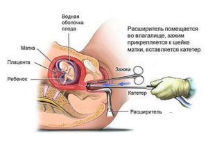 Можно ли после чистки забеременеть