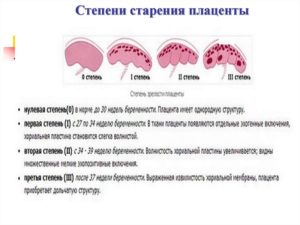 Стареющая плацента беременных причины