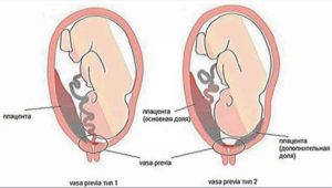 Плацента низкая 20 недель