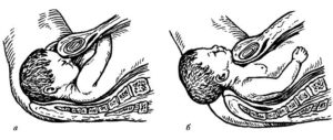 При лобном предлежании доношенного плода родоразрешение проводят
