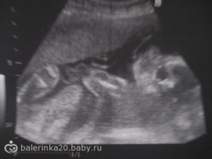 Локальный гипертонус стенки матки при беременности 12 недель