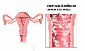 Молочница и беременность последствия