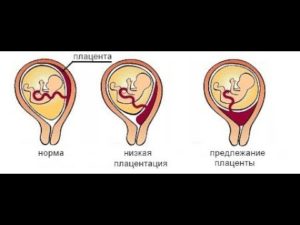 При беременности плацента низко расположена что это значит