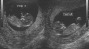 13 недель беременности двойней