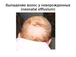 Выпадают ли волосы у новорожденного
