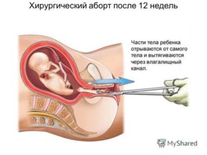 Сколько нельзя беременеть после чистки