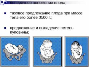 Поперечное предлежание 30 недель
